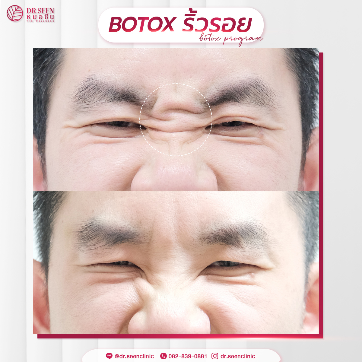 BA BOTOX ริ้วรอย 1